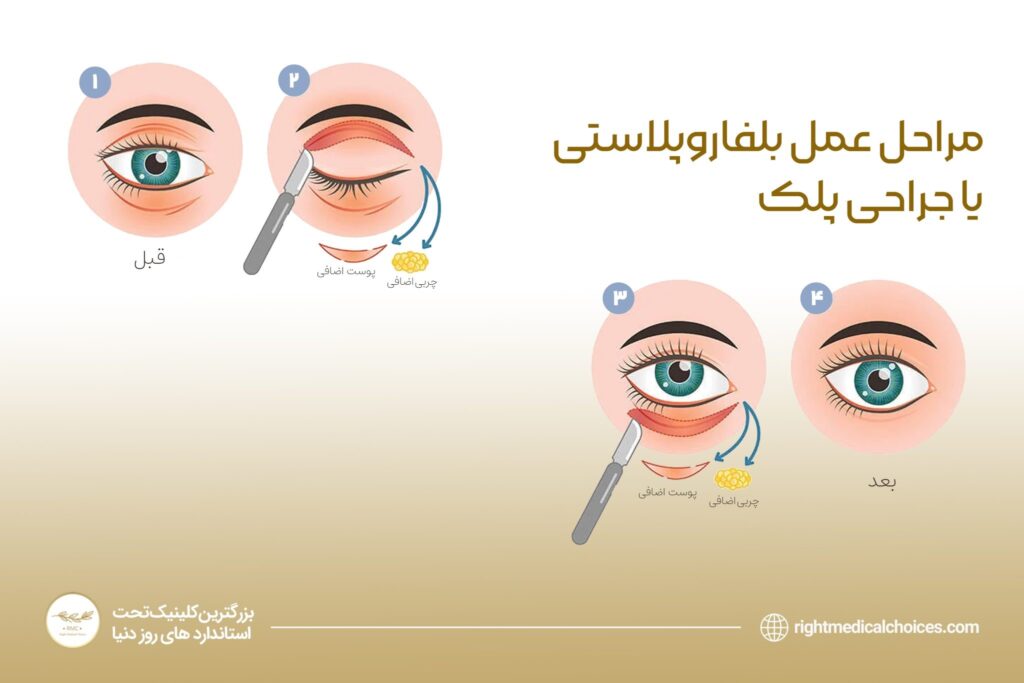 مراحل جراحی پلک در کلینیک RMC